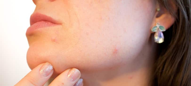 acne on phentermine chin